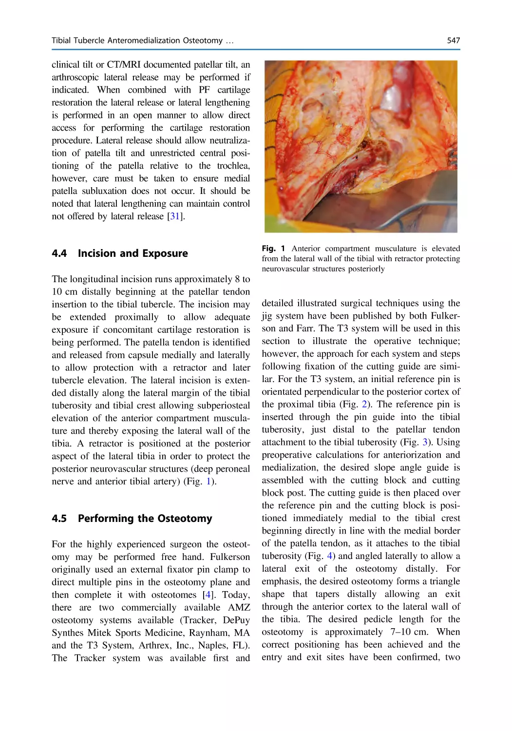 4.4 Incision and Exposure
4.5 Performing the Osteotomy