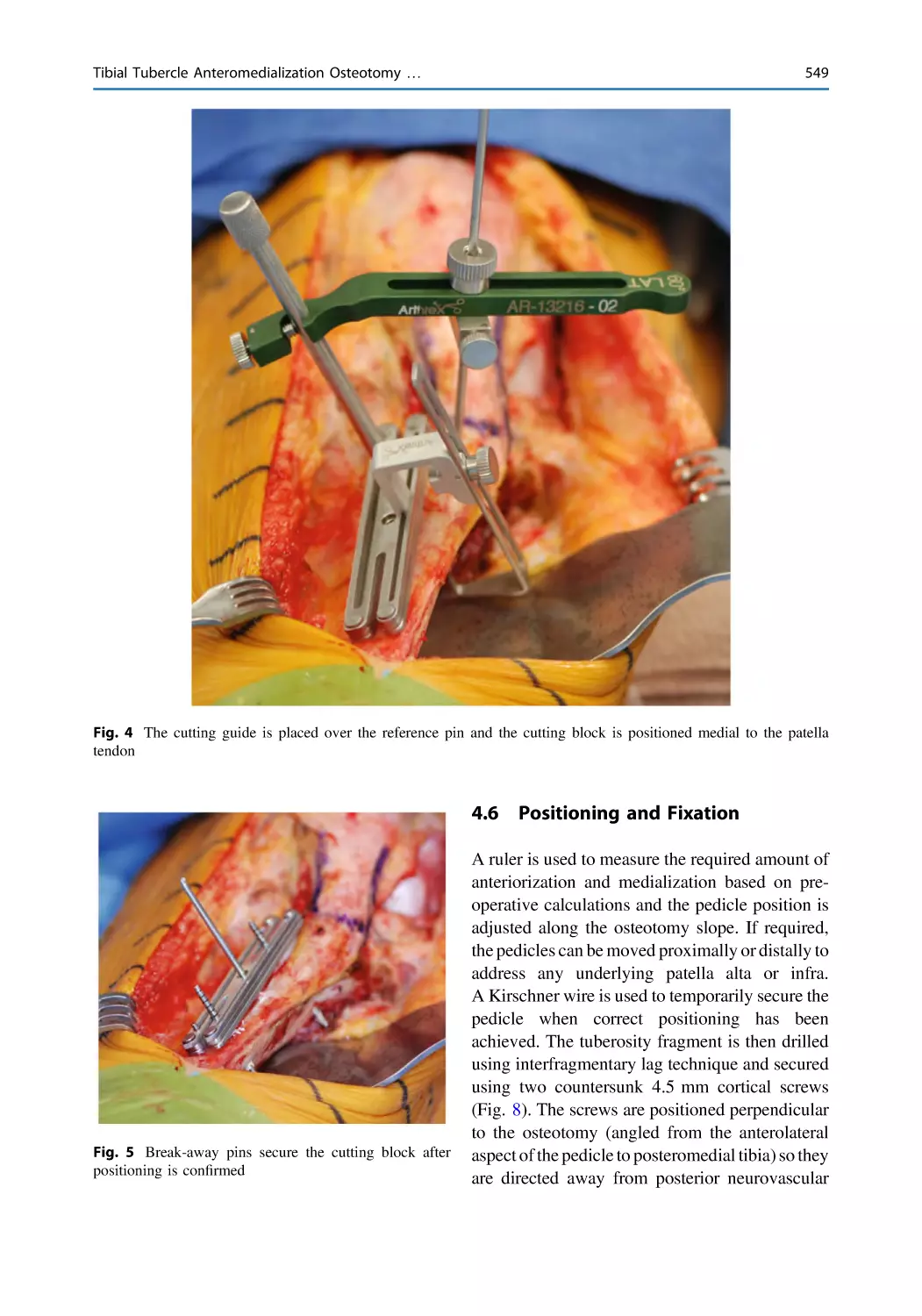 4.6 Positioning and Fixation