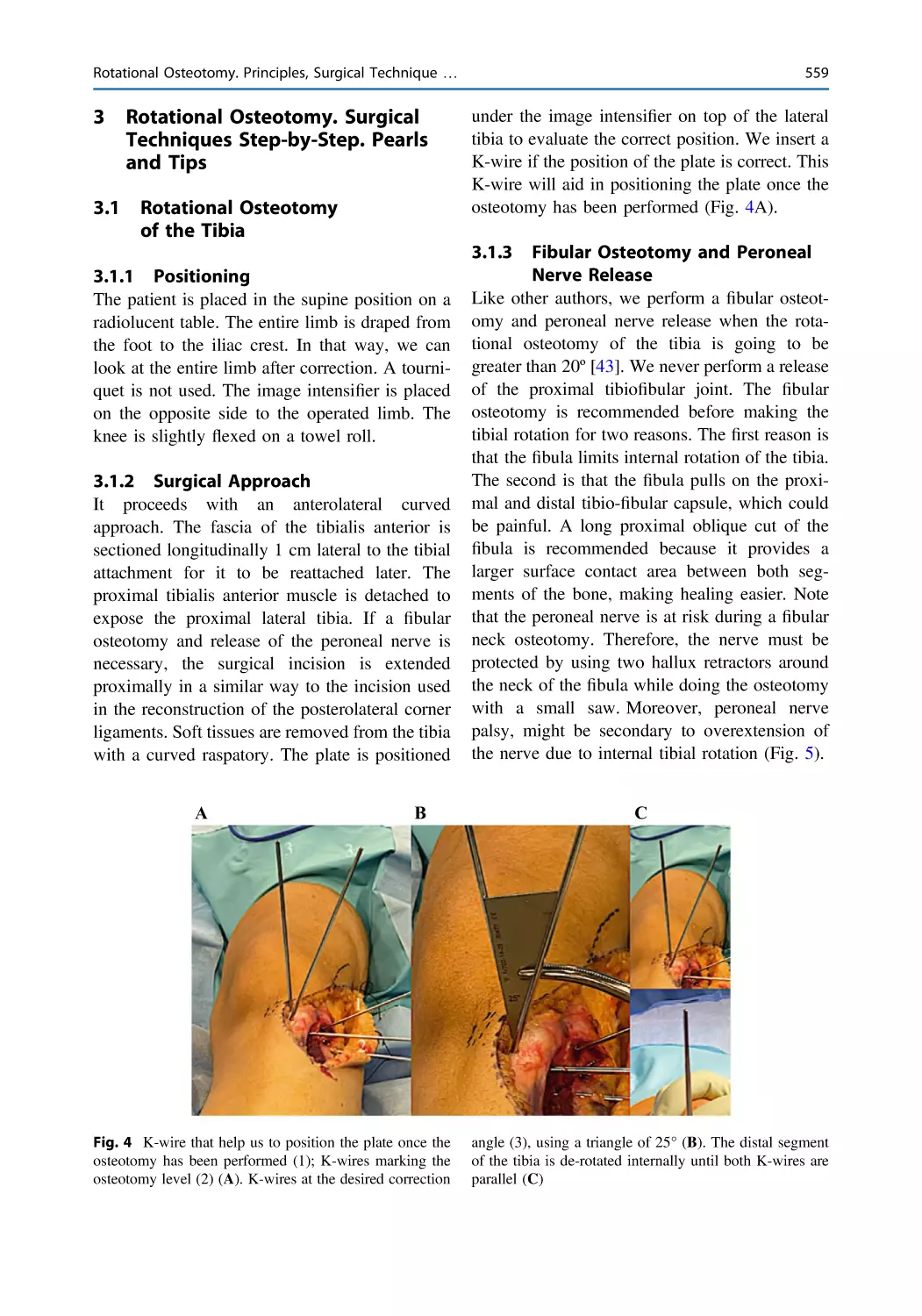 3 Rotational Osteotomy. Surgical Techniques Step-by-Step. Pearls and Tips
3.1 Rotational Osteotomy of the Tibia
3.1.1 Positioning
3.1.2 Surgical Approach
3.1.3 Fibular Osteotomy and Peroneal Nerve Release