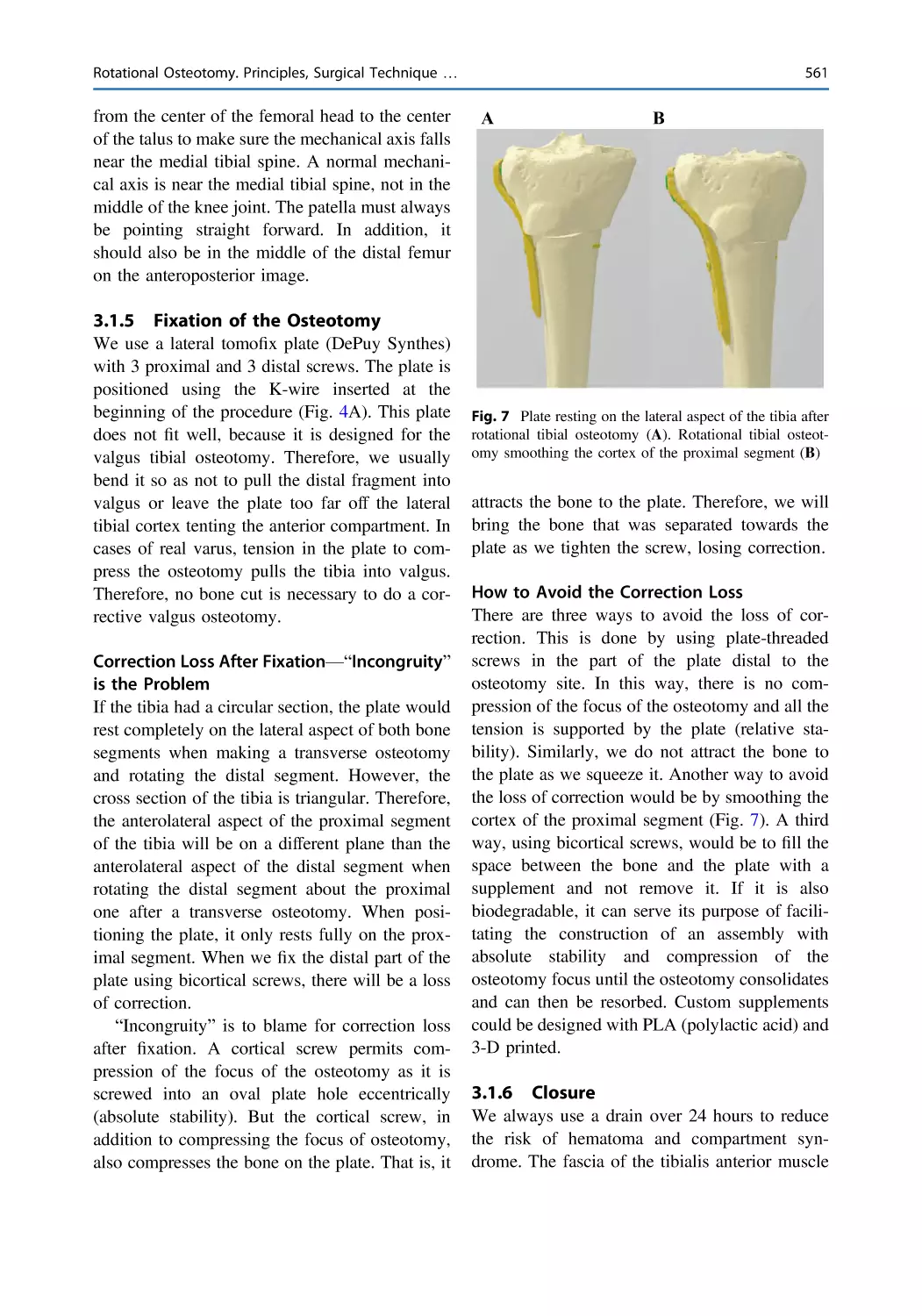 3.1.5 Fixation of the Osteotomy
Correction Loss After Fixation—“Incongruity” is the Problem
How to Avoid the Correction Loss
3.1.6 Closure