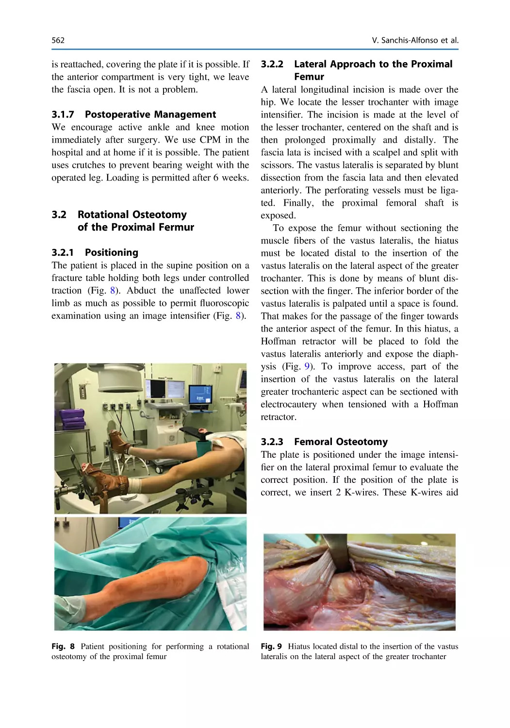 3.1.7 Postoperative Management
3.2 Rotational Osteotomy of the Proximal Fermur
3.2.1 Positioning
3.2.2 Lateral Approach to the Proximal Femur
3.2.3 Femoral Osteotomy