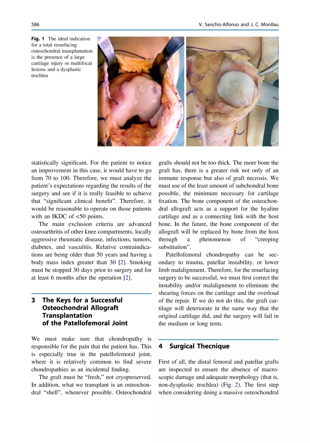 3 The Keys for a Successful Osteochondral Allograft Transplantation of the Patellofemoral Joint
4 Surgical Thecnique