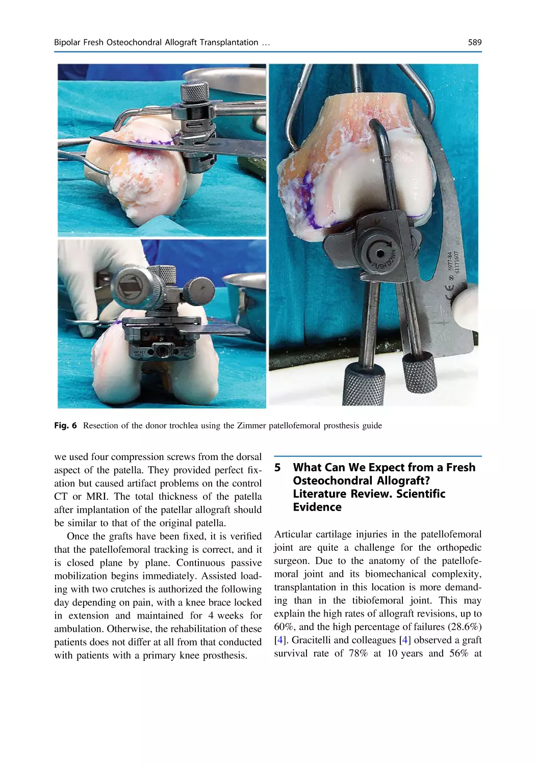 5 What Can We Expect from a Fresh Osteochondral Allograft? Literature Review. Scientific Evidence