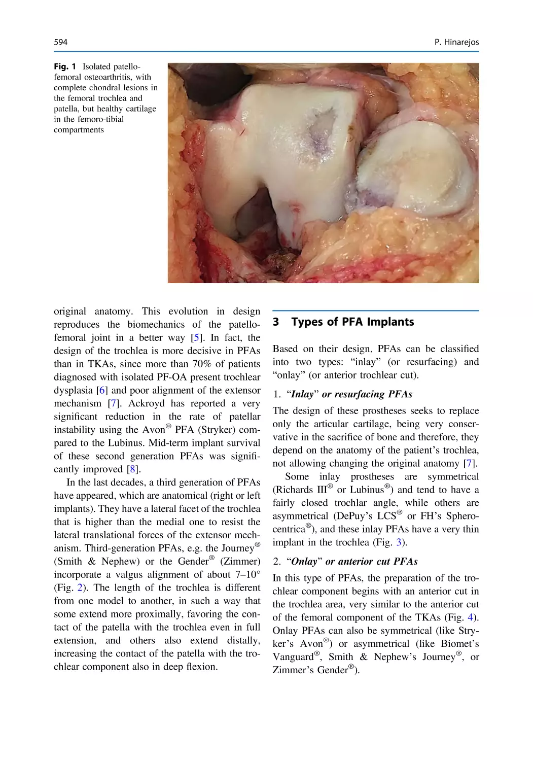 3 Types of PFA Implants