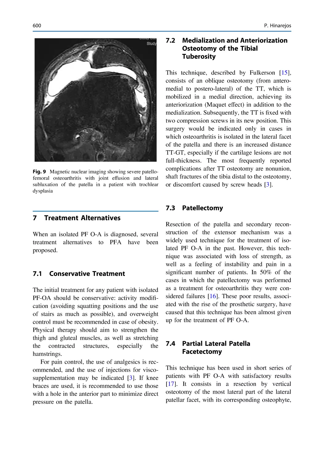 7 Treatment Alternatives
7.1 Conservative Treatment
7.2 Medialization and Anteriorization Osteotomy of the Tibial Tuberosity
7.3 Patellectomy
7.4 Partial Lateral Patella Facetectomy