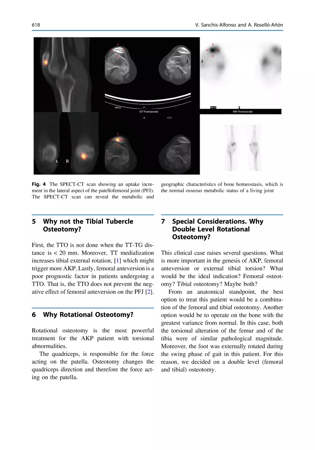 5 Why not the Tibial Tubercle Osteotomy?
6 Why Rotational Osteotomy?
7 Special Considerations. Why Double Level Rotational Osteotomy?