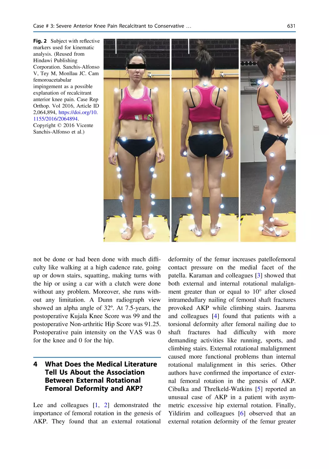 4 What Does the Medical Literature Tell Us About the Association Between External Rotational Femoral Deformity and AKP?