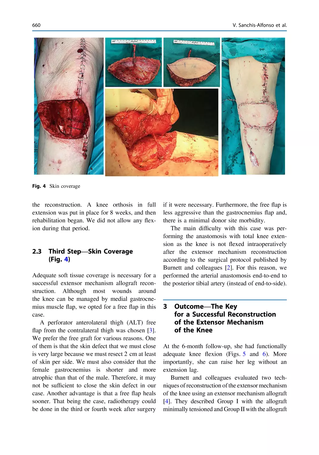 2.3 Third Step—Skin Coverage (Fig. 4)
3 Outcome—The Key for a Successful Reconstruction of the Extensor Mechanism of the Knee