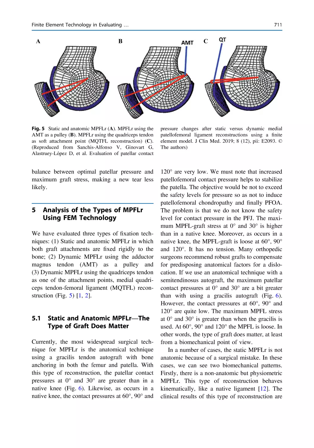 5 Analysis of the Types of MPFLr Using FEM Technology
5.1 Static and Anatomic MPFLr—The Type of Graft Does Matter