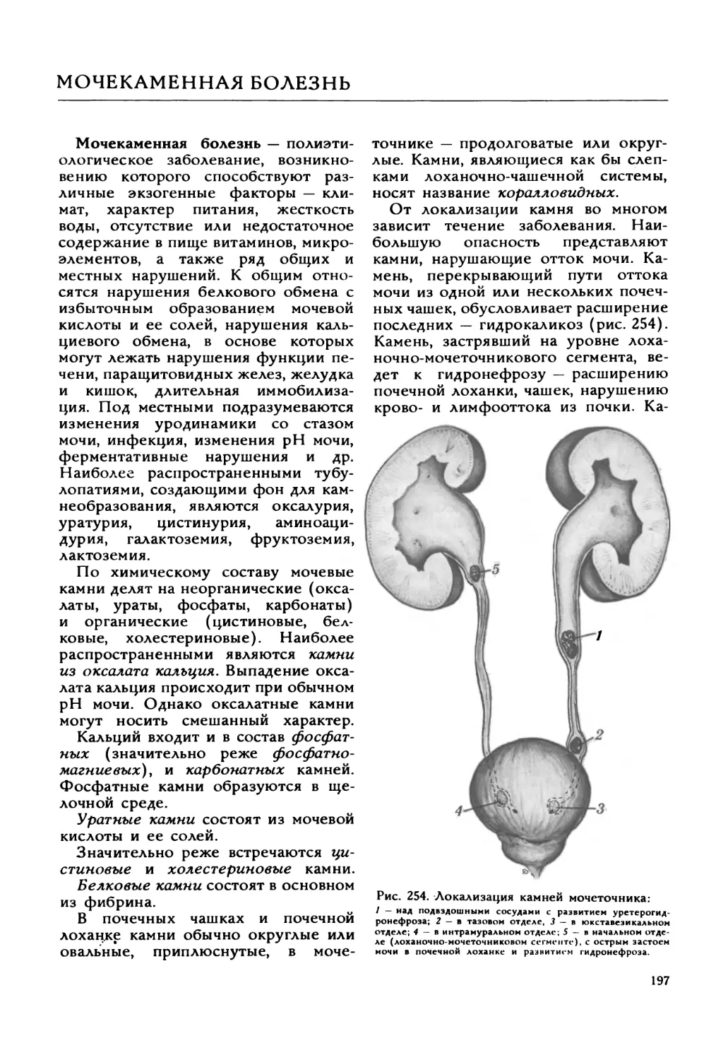 Мочекаменная болезнь