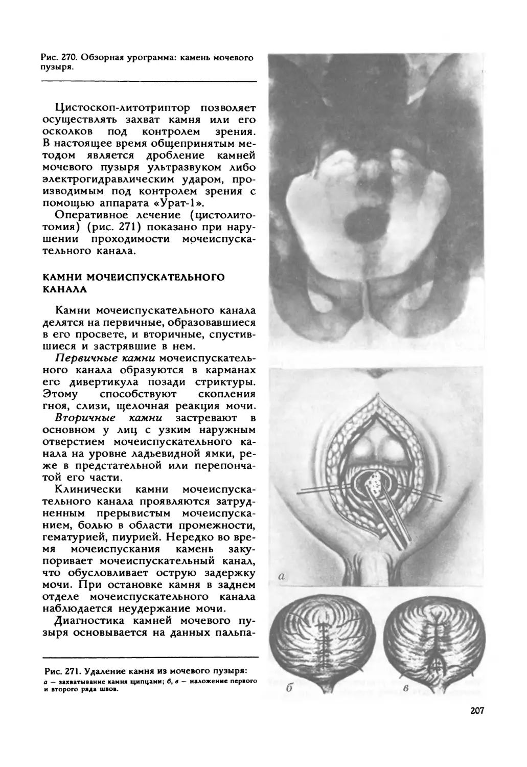 Камни мочеиспускательного канала