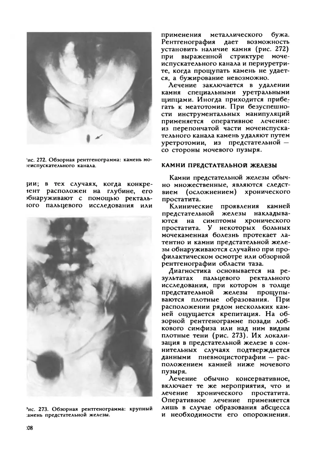 Камни предстательной железы